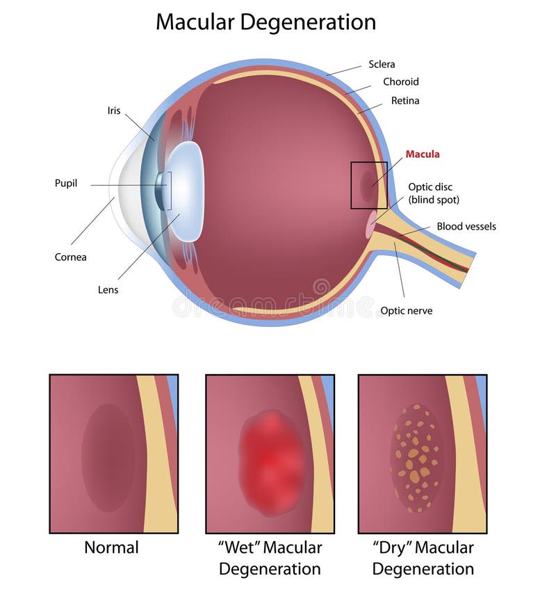 εκφυλισμός macular ελεύθερη απεικόνιση δικαιώματος εκφυλισμός macular ελεύθερη απεικόνιση δικαιώματος