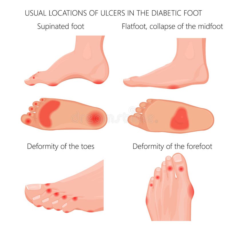 Illustration of usual locations of ulcers in the diabetic foot. Used: gradient, transparency, blend, blend mode. Illustration of usual locations of ulcers in the diabetic foot. Used: gradient, transparency, blend, blend mode.