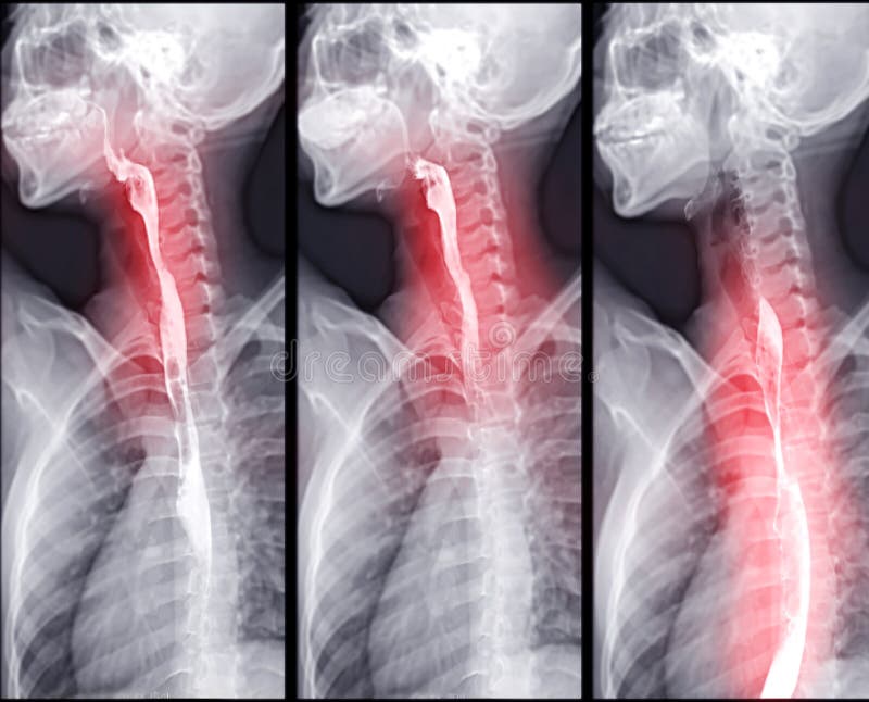 Barium Swallow study test diagnose Barrett`s GI tract exam GERD ulcers series difficulty pharynx procedure UGI throat bowel therapy by fluoroscopy devices. Barium Swallow study test diagnose Barrett`s GI tract exam GERD ulcers series difficulty pharynx procedure UGI throat bowel therapy by fluoroscopy devices