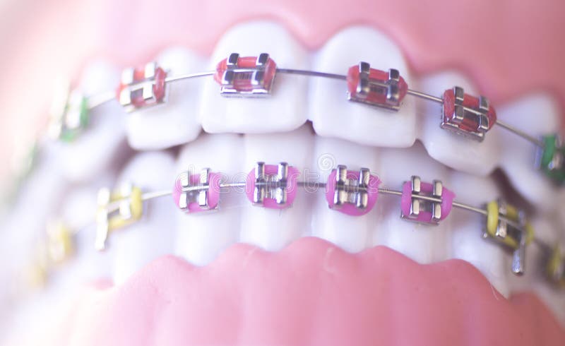 Καλλυντικά οδοντικά υποστηρίγματα μετάλλων