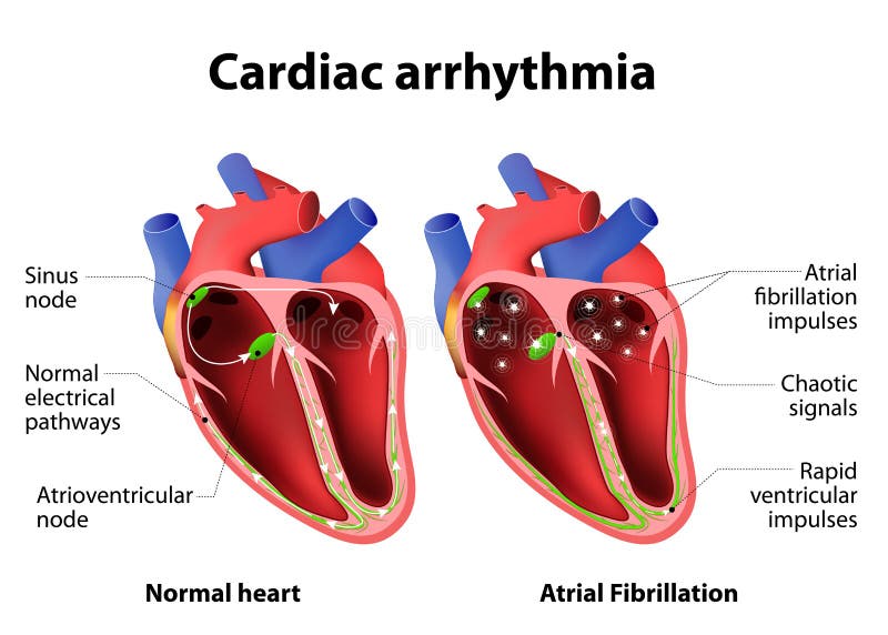 Cardiac arrhythmia. cardiac dysrhythmia or irregular heartbeat. Medical illustration. Cardiac arrhythmia. cardiac dysrhythmia or irregular heartbeat. Medical illustration