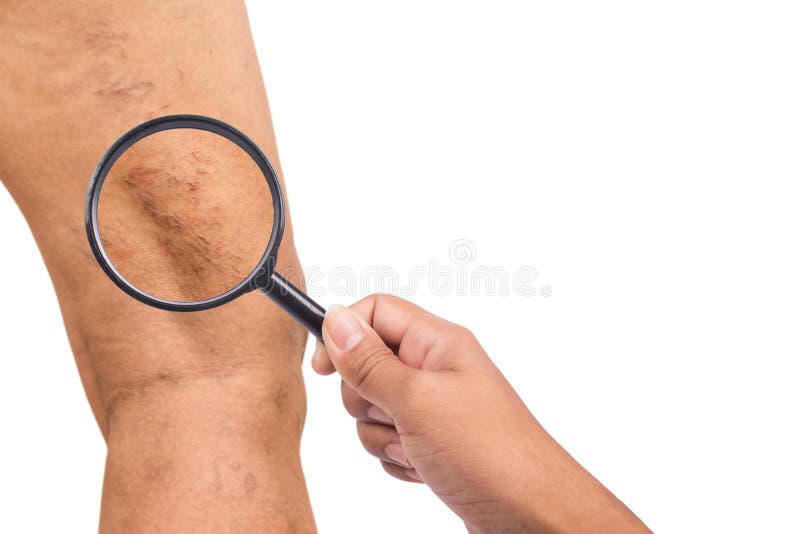 Κιρσώδεις φλέβες στα πόδια των μέσης ηλικίας γυναικών στοκ φωτογραφία με δικαίωμα ελεύθερης χρήσης Κιρσώδεις φλέβες στα πόδια των μέσης ηλικίας γυναικών στοκ φωτογραφία με δικαίωμα ελεύθερης χρήσης