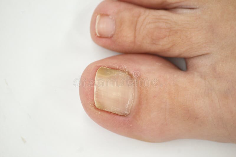 Big toenail of a person suffering from onychomycosis, a fungal infection that causes yellowing of the nail. Big toenail of a person suffering from onychomycosis, a fungal infection that causes yellowing of the nail