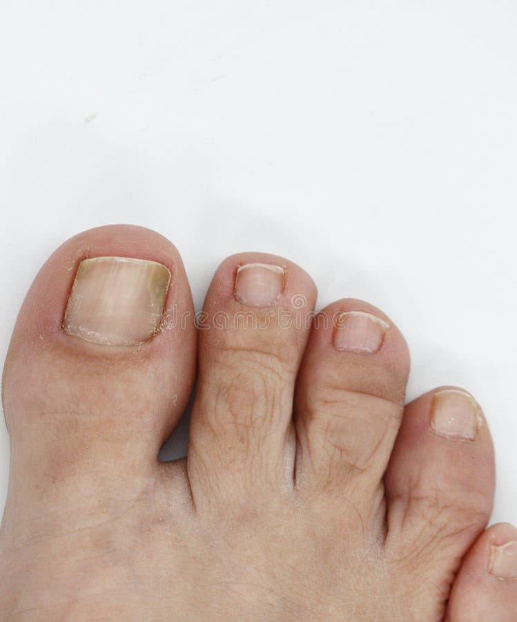 Big toenail of a person suffering from onychomycosis, a fungal infection that causes yellowing of the nail. Big toenail of a person suffering from onychomycosis, a fungal infection that causes yellowing of the nail