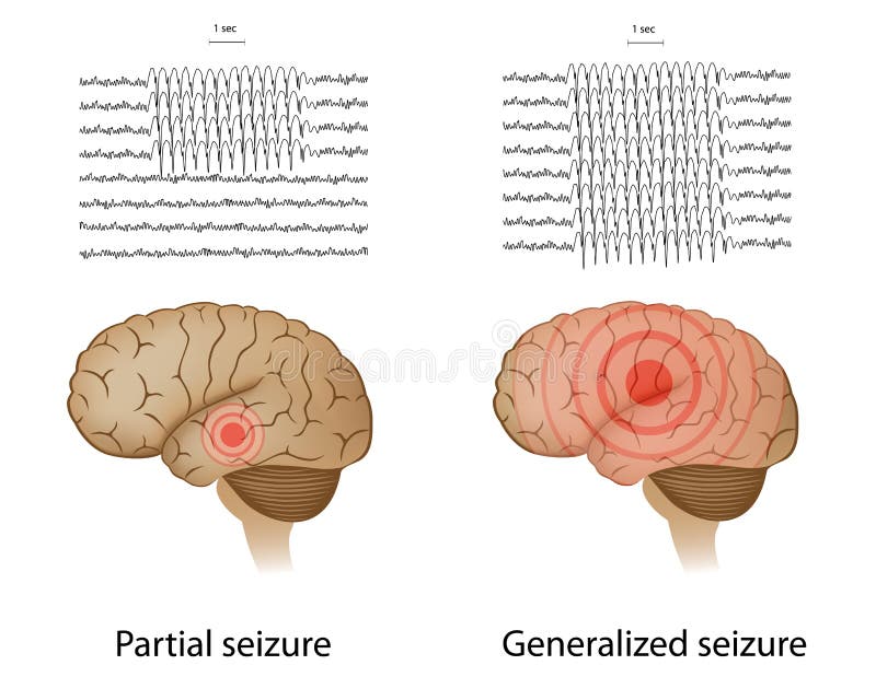 EEG in partial and generalized seizures. EEG in partial and generalized seizures