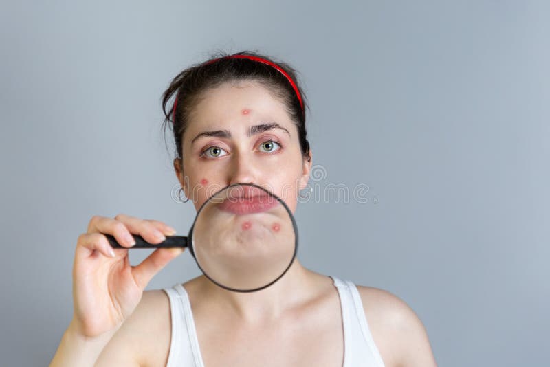 Μια νέα γυναίκα κρατά μια ενίσχυση - γυαλί στο πρόσωπό της, που παρουσιάζει σπυράκια στο πηγούνι της Η έννοια cosmetology και της