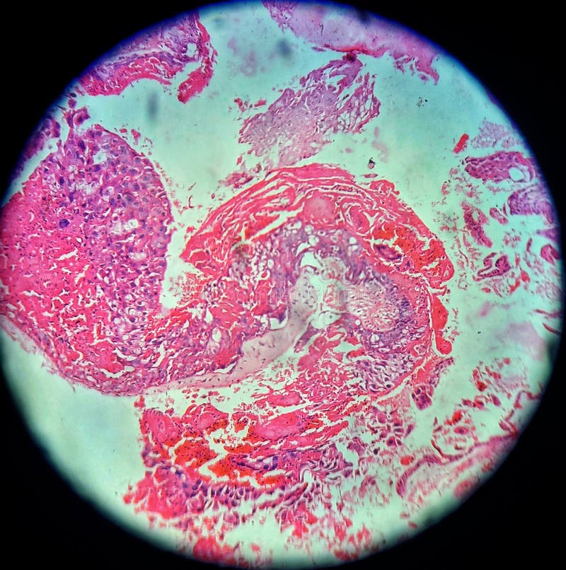 This image is of a placental tumor known as Hydatiform mole .
This is having 2 components villous and trophoblastic . This image is of a placental tumor known as Hydatiform mole .
This is having 2 components villous and trophoblastic .