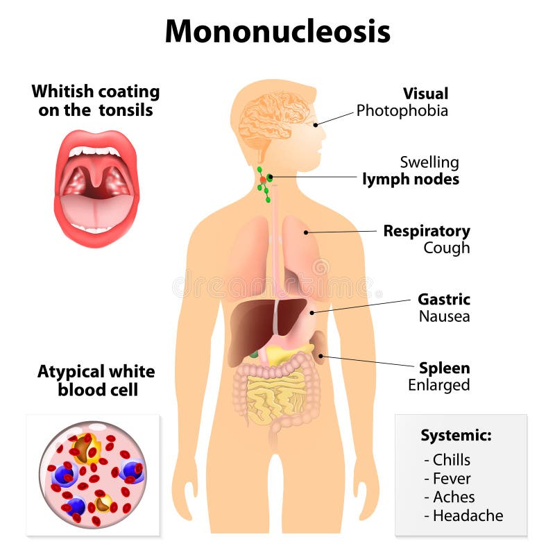 Mononucleosis. Signs and symptoms of infectious mononucleosis. Human silhouette with internal organs. glandular fever, Pfeiffer's disease or Filatov's disease. Mononucleosis. Signs and symptoms of infectious mononucleosis. Human silhouette with internal organs. glandular fever, Pfeiffer's disease or Filatov's disease