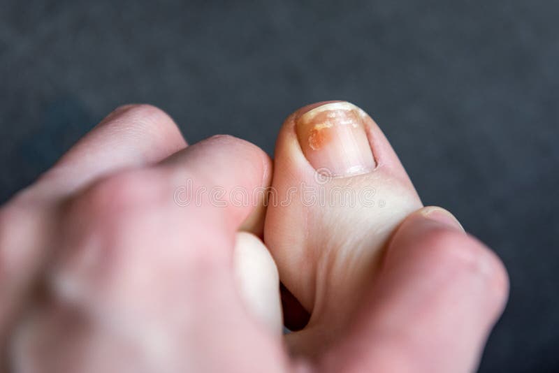μύκητας ή ονυχόλυση σε ένα toenail μετά από στενά υποδήματα ή χρησιμοποιώντας ζελακέτες.