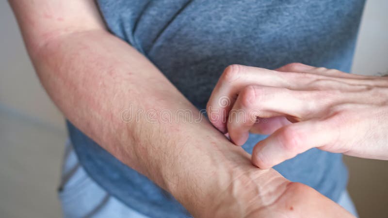 ο nan γρατζουνίζει τον βραχίονα με το χέρι υποφέροντας από φαγούρα στο δέρμα στοκ εικόνες με δικαίωμα ελεύθερης χρήσης