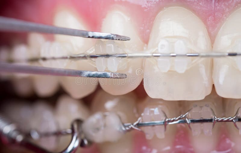 Οδοντίατρος που ελέγχει επάνω τα δόντια με τα κεραμικά υποστηρίγματα, που χρησιμοποιούν τα αντίστροφα τσιμπιδάκια Μακρο πυροβολισ