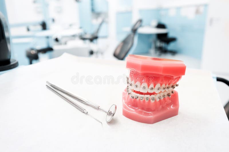 Οδοντικό πρότυπο με τα στηρίγματα - orthodontic οδοντικό πρότυπο δοντιών με τα οδοντικά στηρίγματα στην κλινική οδοντιάτρων στοκ εικόνα με δικαίωμα ελεύθερης χρήσης Οδοντικό πρότυπο με τα στηρίγματα - orthodontic οδοντικό πρότυπο δοντιών με τα οδοντικά στηρίγματα στην κλινική οδοντιάτρων στοκ εικόνα με δικαίωμα ελεύθερης χρήσης