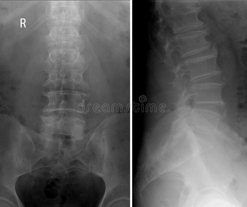 οσφυική σπονδυλική στήλη Χ ακτίνων Spondylosis παραμόρφωσης πλευρικές και βελονοειδείς προβολές στοκ εικόνες με δικαίωμα ελεύθερης χρήσης οσφυική σπονδυλική στήλη Χ ακτίνων Spondylosis παραμόρφωσης πλευρικές και βελονοειδείς προβολές στοκ εικόνες με δικαίωμα ελεύθερης χρήσης