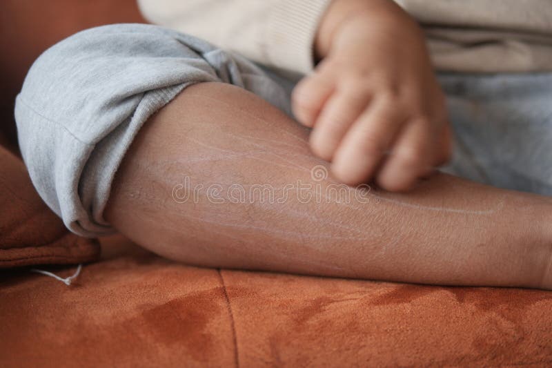 παιδί που υποφέρει από φαγούρα στοκ εικόνες