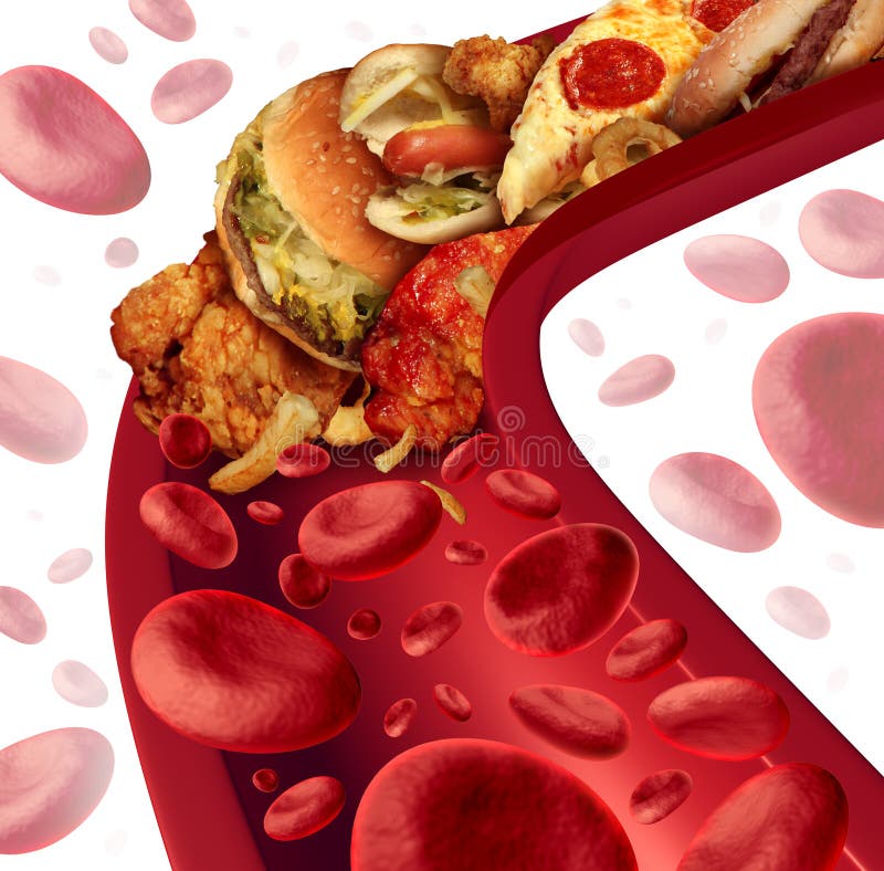 Cholesterol blocked artery medical concept with a human blood vessel that is clogged by unhealthy food as hamburgers and fried foods as a health risk metaphor for dieting and nutrition problems as eating fat. Cholesterol blocked artery medical concept with a human blood vessel that is clogged by unhealthy food as hamburgers and fried foods as a health risk metaphor for dieting and nutrition problems as eating fat.