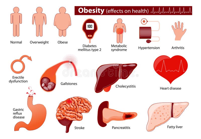 Obesity and overweight infographic. Effects on health. Medical infographic. Set elements and symbols for your design. Obesity and overweight infographic. Effects on health. Medical infographic. Set elements and symbols for your design.