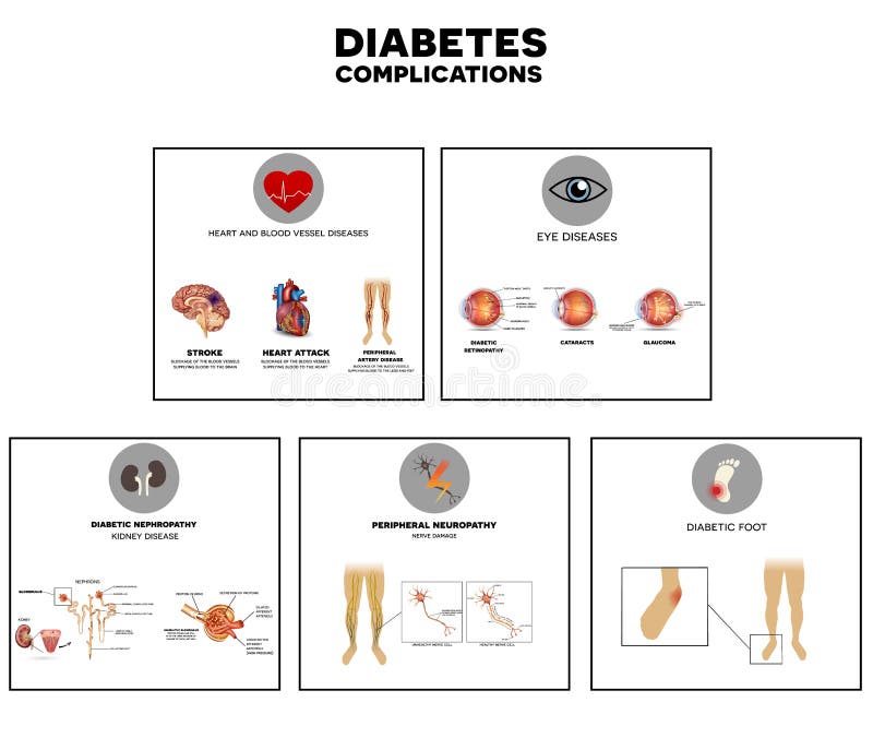 Diabetes complications affected organs. Diabetes affects nerves, kidneys, eyes, vessels, heart and skin. Diabetes complications affected organs. Diabetes affects nerves, kidneys, eyes, vessels, heart and skin.