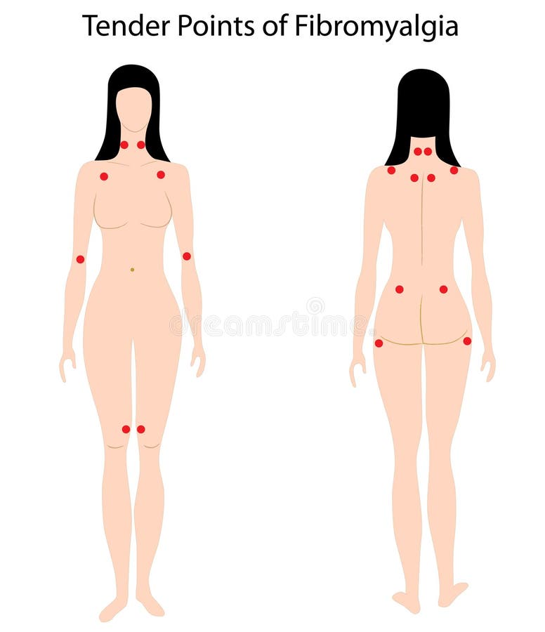 Illustration of paired tender points used for diagnosis of fibromyalgia, eps8. Illustration of paired tender points used for diagnosis of fibromyalgia, eps8