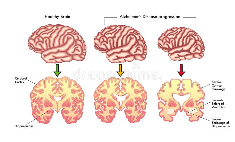 Medical illustration of the symptoms of Alzheimer's disease progression. Medical illustration of the symptoms of Alzheimer's disease progression