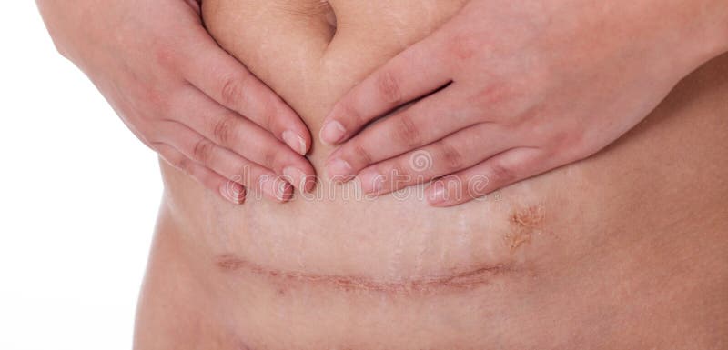 Σημάδι μετά από ένα τμήμα Caesarean, γραμμή μπικινιών στοκ φωτογραφίες με δικαίωμα ελεύθερης χρήσης Σημάδι μετά από ένα τμήμα Caesarean, γραμμή μπικινιών στοκ φωτογραφίες με δικαίωμα ελεύθερης χρήσης