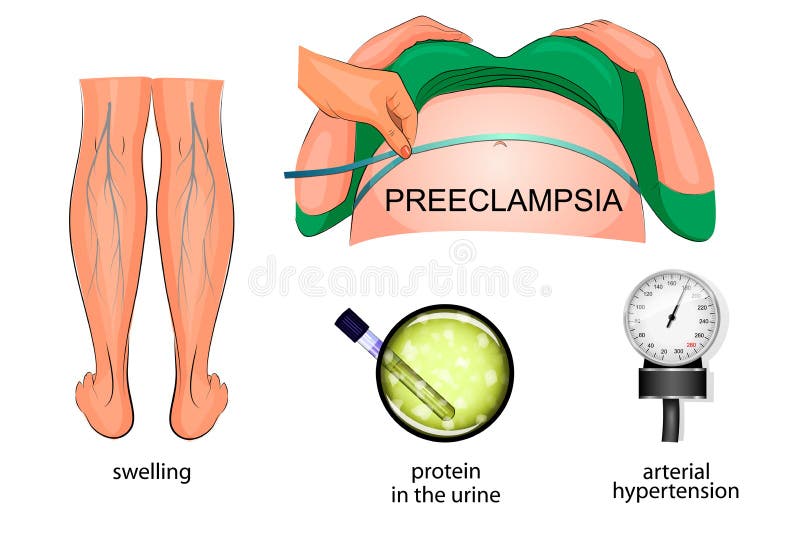 The symptoms of eclampsia during pregnancy: swelling of the feet, hypertension and protein in the urine. The symptoms of eclampsia during pregnancy: swelling of the feet, hypertension and protein in the urine