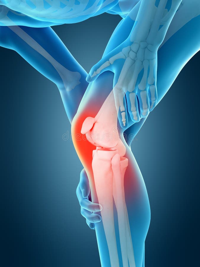 Medically accurate 3d illustration of knee pain. Medically accurate 3d illustration of knee pain