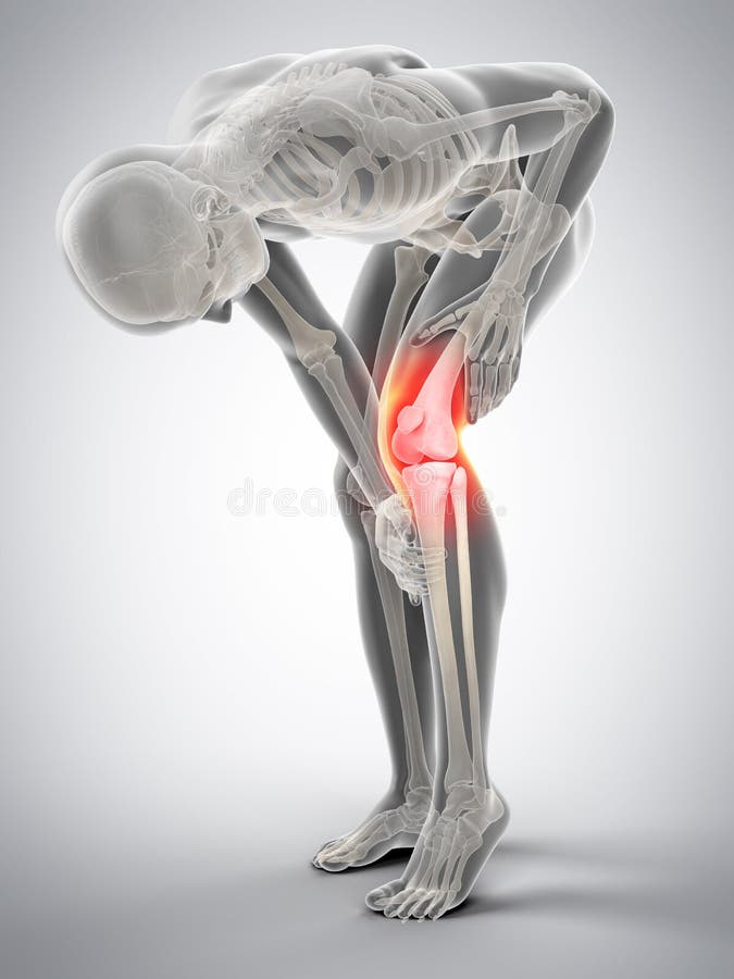 Medically accurate 3d illustration of knee pain. Medically accurate 3d illustration of knee pain