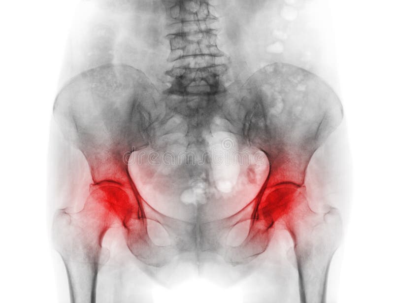 Film x-ray pelvis of osteoporosis patient and arthritis both hip . Film x-ray pelvis of osteoporosis patient and arthritis both hip .