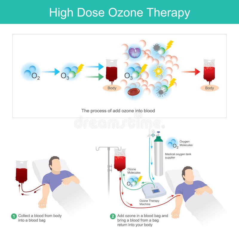High Dose Ozone Therapy. This process add ozone in a blood bag and bring a blood from a bag return into your body. High Dose Ozone Therapy. This process add ozone in a blood bag and bring a blood from a bag return into your body