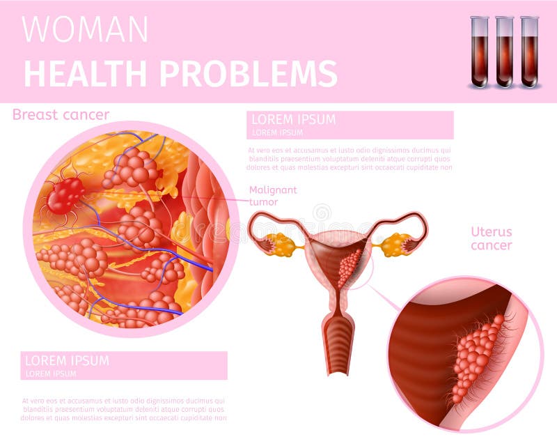 Causas de cancer de utero