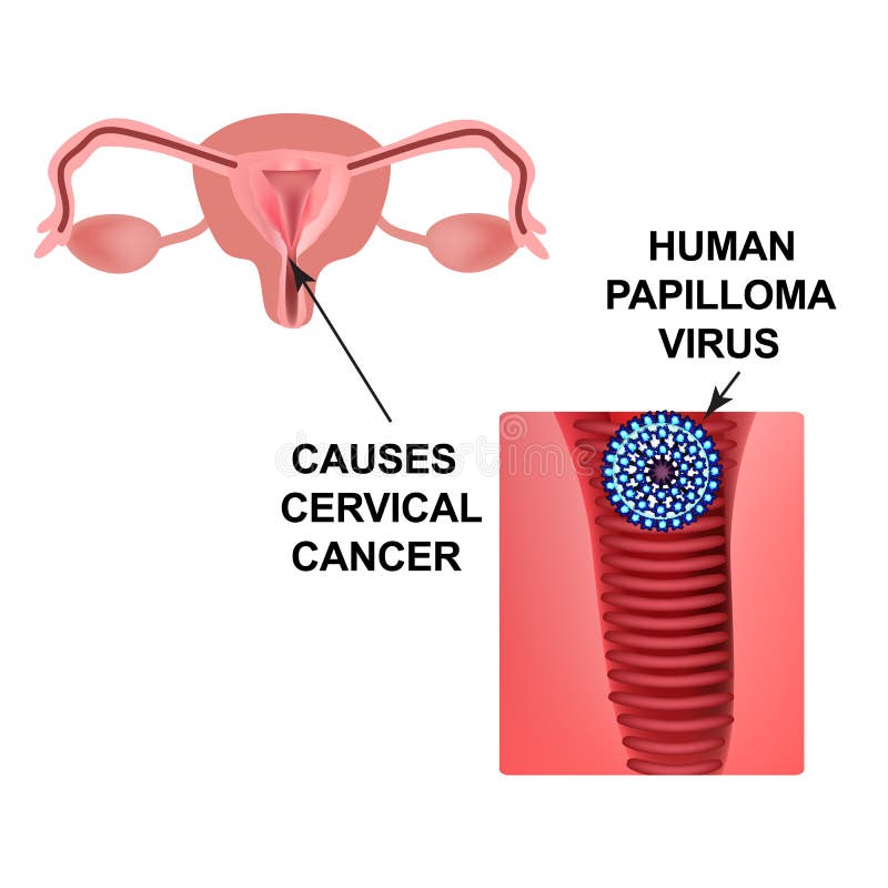 labialis papilloma vírus papilloma különbség condyloma