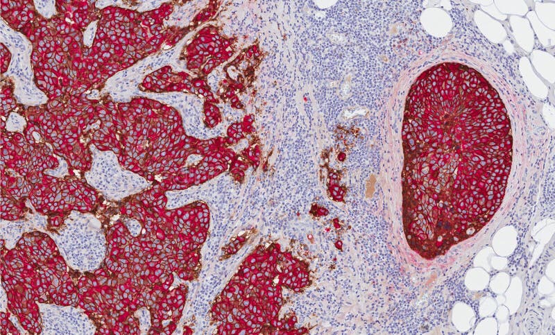 Breast cancer stained for prognostic marker HER-2 (red). Breast cancer stained for prognostic marker HER-2 (red)