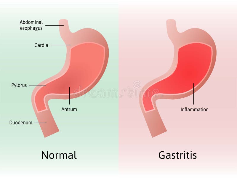 Que es gastritis antral