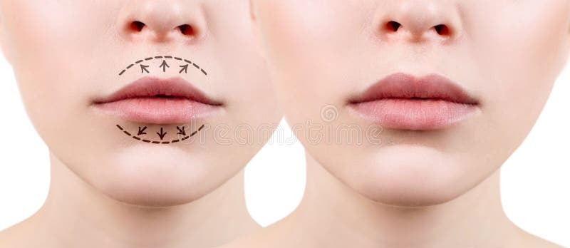 Lips files before after