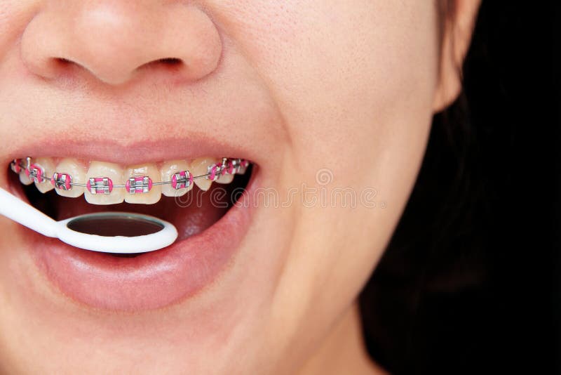 Girl smiling with braces on teeth. Girl smiling with braces on teeth