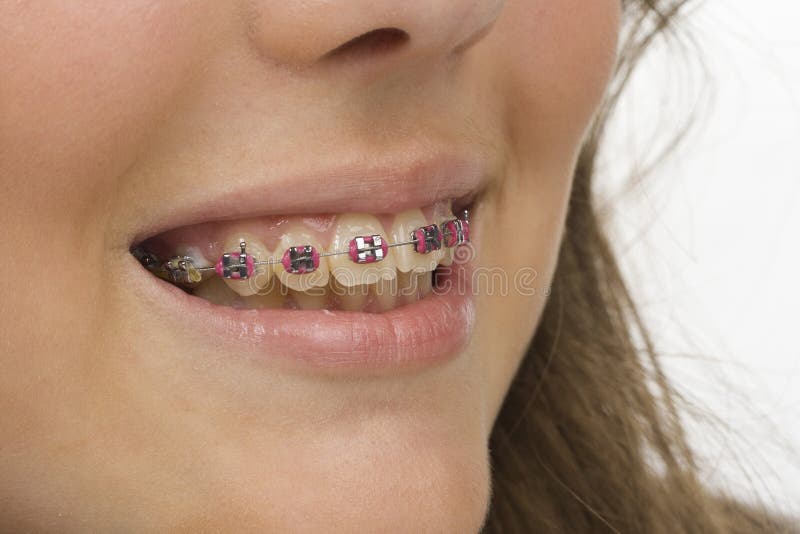 Bright mouth with braces and young woman smile. Bright mouth with braces and young woman smile