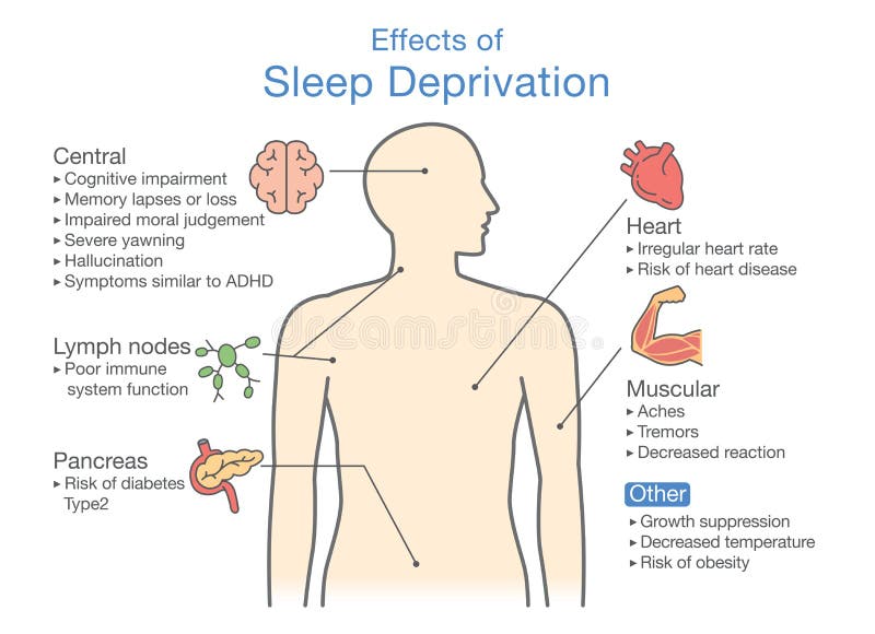 Diagram of Effects of Sleep deprivation. Illustration about disease diagnosis. Diagram of Effects of Sleep deprivation. Illustration about disease diagnosis.