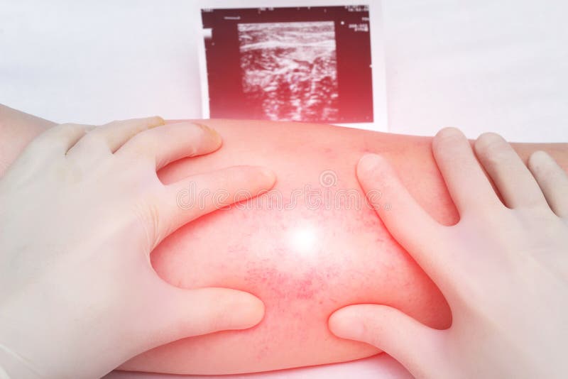 A doctor in gloves examines the veins and legs of the patient for the presence of thrombosis and varicose veins of the extremities, close-up, white background, ultrasound shot. A doctor in gloves examines the veins and legs of the patient for the presence of thrombosis and varicose veins of the extremities, close-up, white background, ultrasound shot