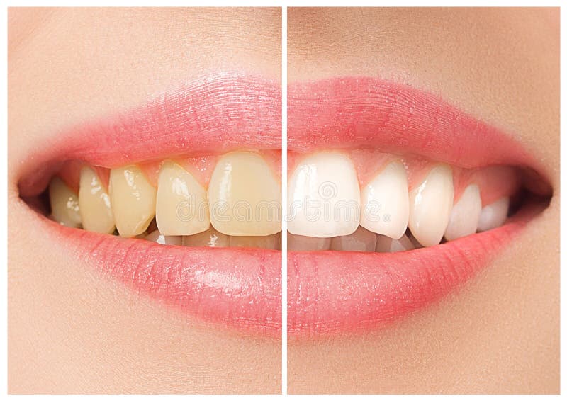 The female teeth before and after whitening. Collage. The female teeth before and after whitening. Collage