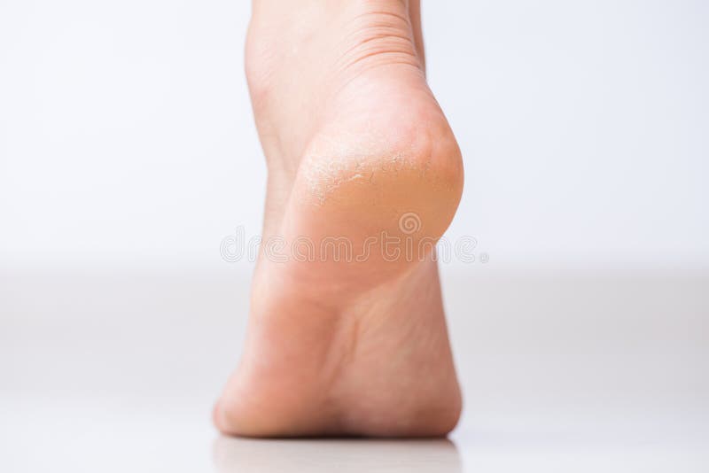 Close up of Cracks on Heels with bad skin covered. Healthcare and medical concept. Close up of Cracks on Heels with bad skin covered. Healthcare and medical concept.