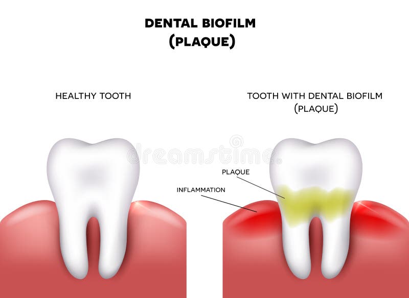 Dental plaque with inflammation and healthy tooth on a white background. Dental plaque with inflammation and healthy tooth on a white background