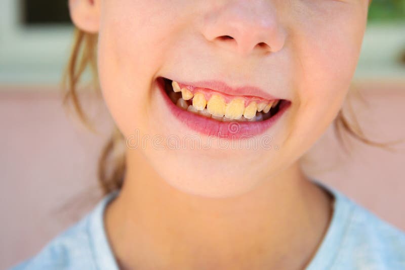 Dental plaque in teenager. Close up of yellow teeth. Dental plaque in teenager. Close up of yellow teeth