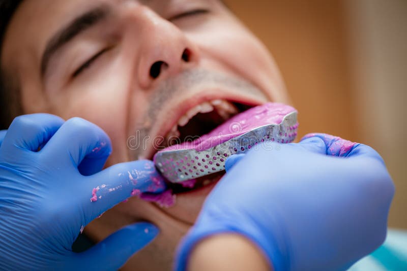 Dentist using dental impression for braces to the male patient. Close-up. Real people. Dentist using dental impression for braces to the male patient. Close-up. Real people.