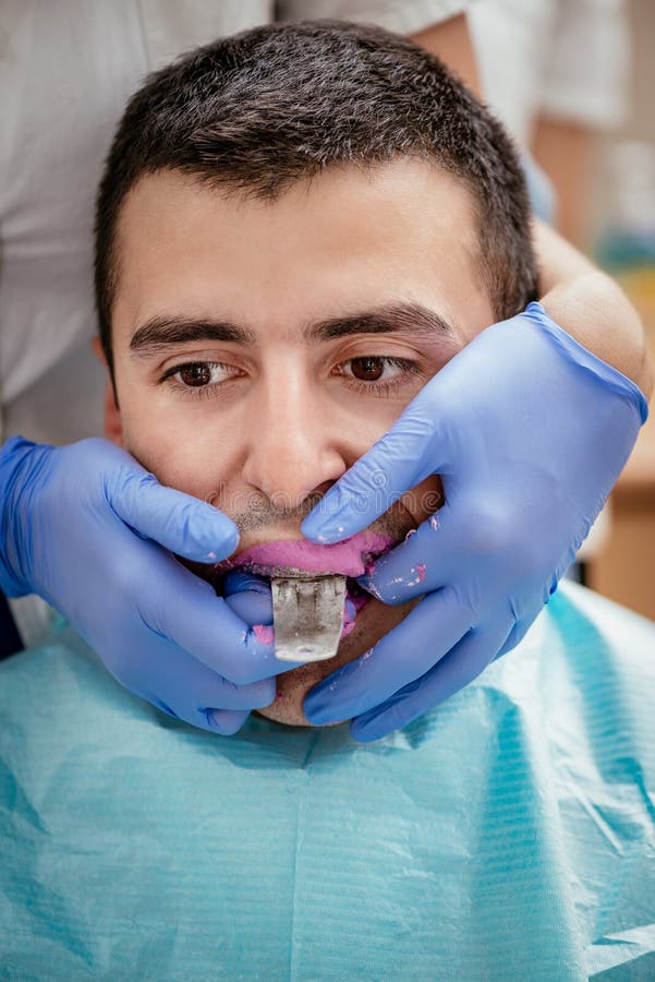 Dentist using dental impression for braces to the male patient. Close-up. Real people. Dentist using dental impression for braces to the male patient. Close-up. Real people.