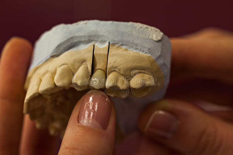 Close Up Of Human Hands Holding Dental Molds of Human Teeth. Close Up Of Human Hands Holding Dental Molds of Human Teeth