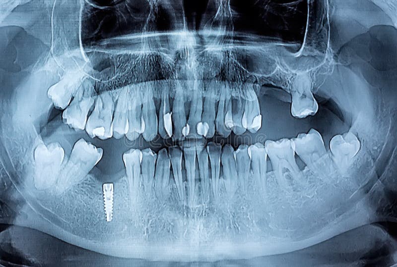 Dental x-ray with periodontitis problems, decayed teeth and implant sample. Dental x-ray with periodontitis problems, decayed teeth and implant sample