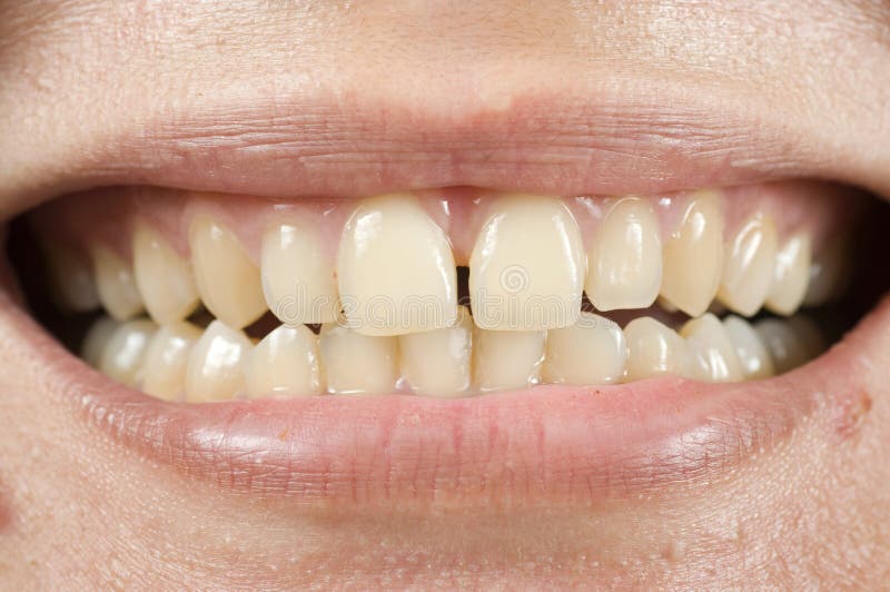 Spacing teeth oral problem, photo for teeth problem. Spacing teeth oral problem, photo for teeth problem