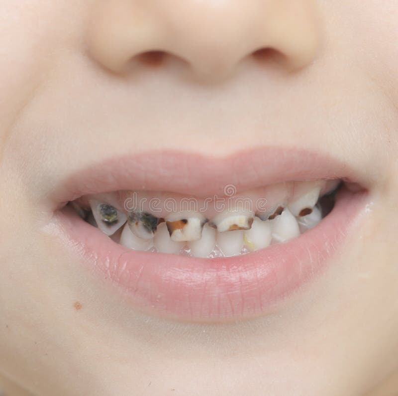 Close up shot of baby teeth with caries. Close up shot of baby teeth with caries