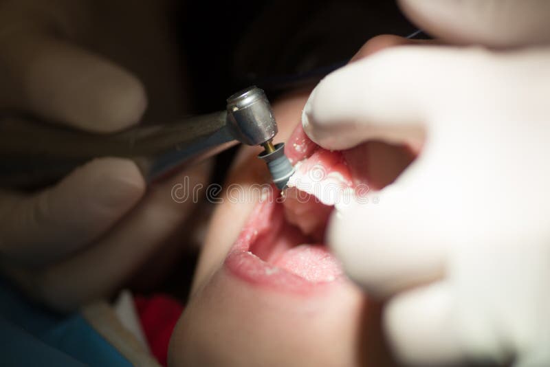 Teeth polishing and cleaning, dentistry. Teeth polishing and cleaning, dentistry
