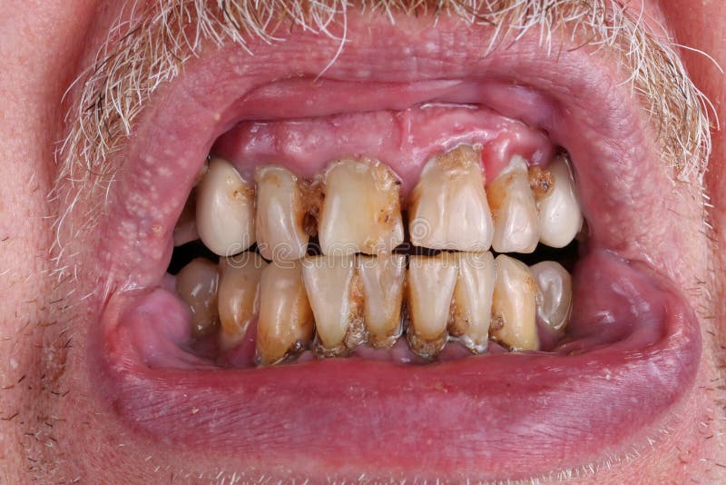 The teeth of an elderly man are spoiled by caries, tartar and poor waste food macro. The harm of alcohol and tobacco concept. Studio macro shot. The teeth of an elderly man are spoiled by caries, tartar and poor waste food macro. The harm of alcohol and tobacco concept. Studio macro shot